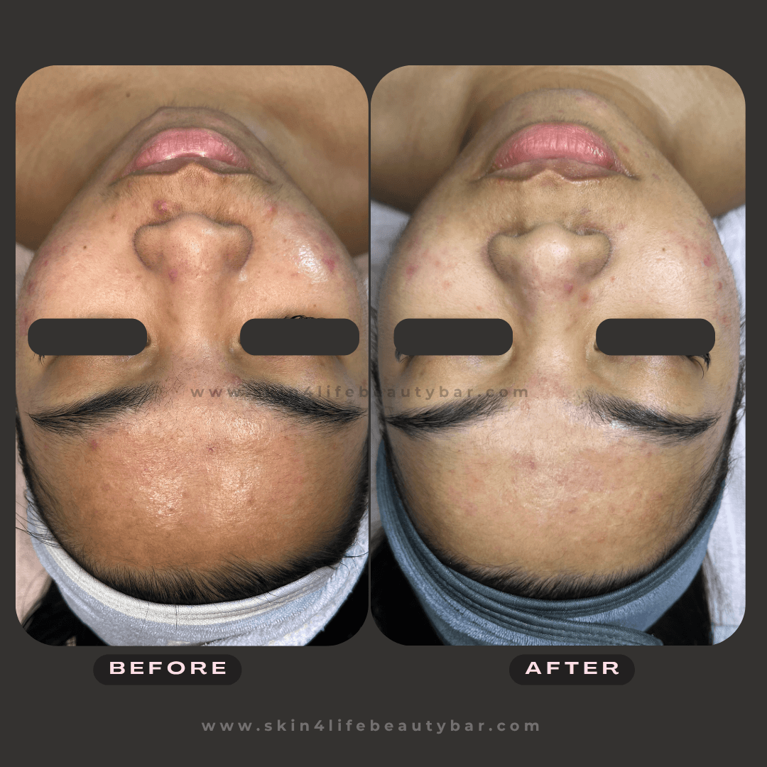 Korean Algae Peel before and after — result 1