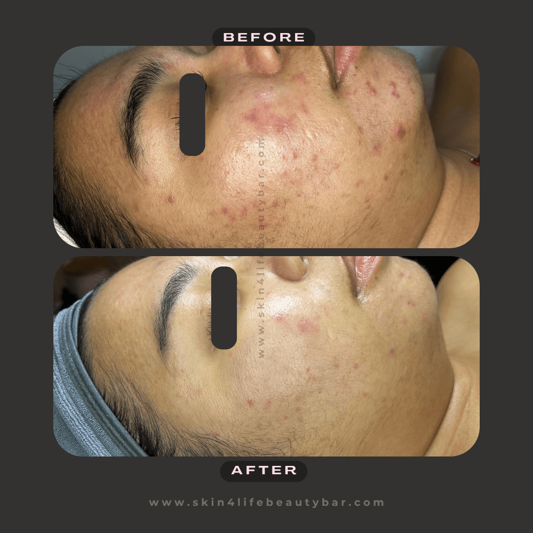 Korean Algae Peel before and after — result 2