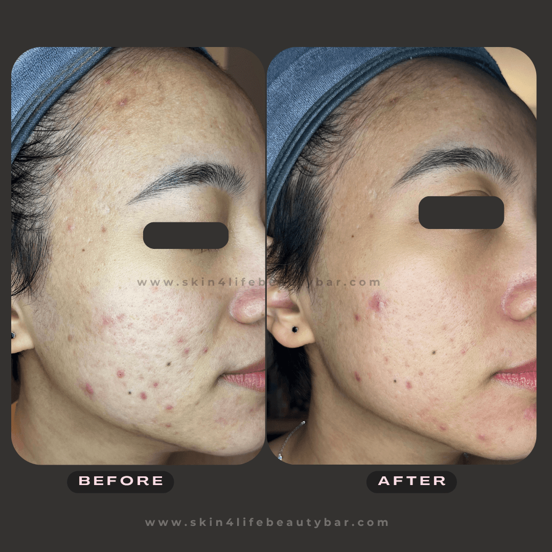 Korean Algae Peel before and after — result 3