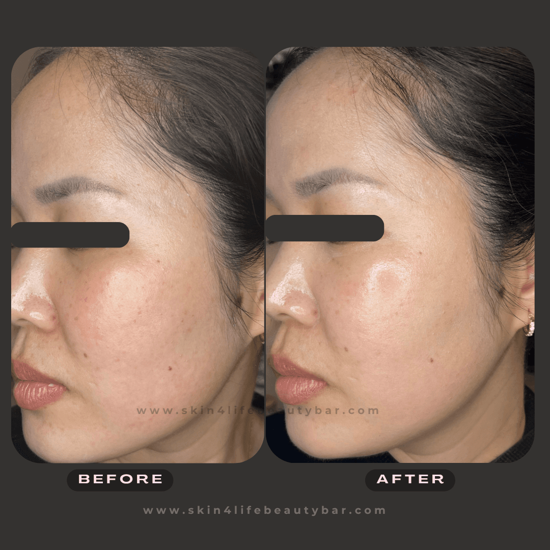 Korean Algae Peel before and after — result 4