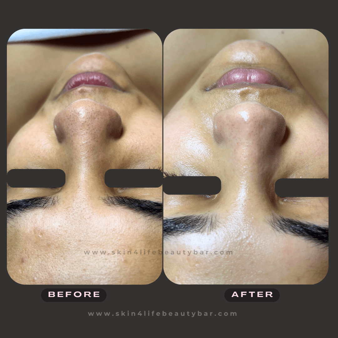 HydroGlow Facial before and after — result 1