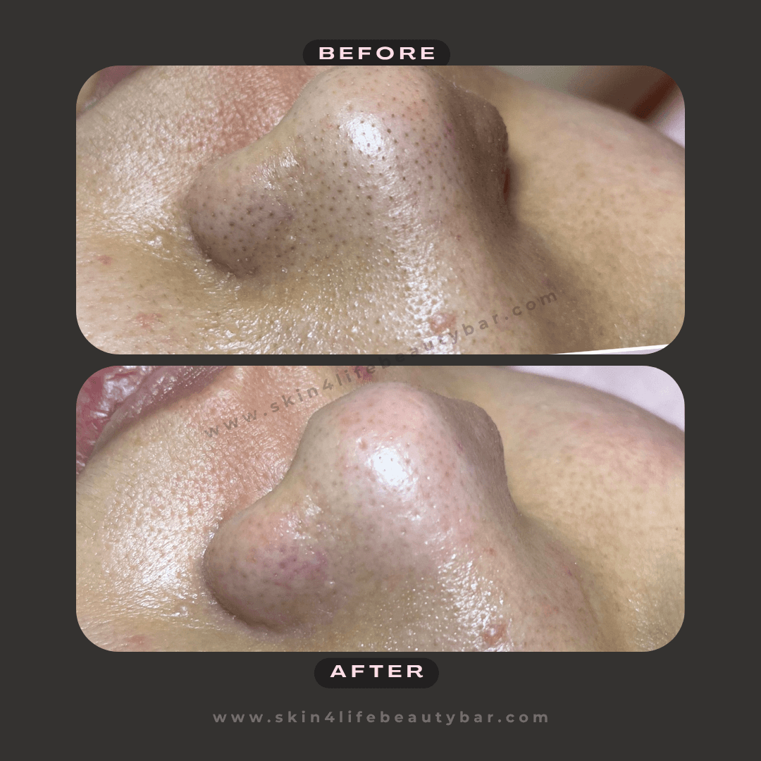 HydroGlow Facial before and after — result 2