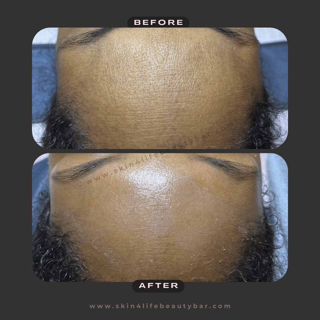 HydroGlow Facial before and after — result 3