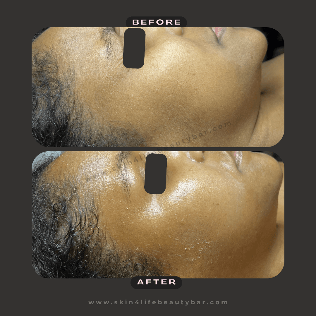 HydroGlow Facial before and after — result 4