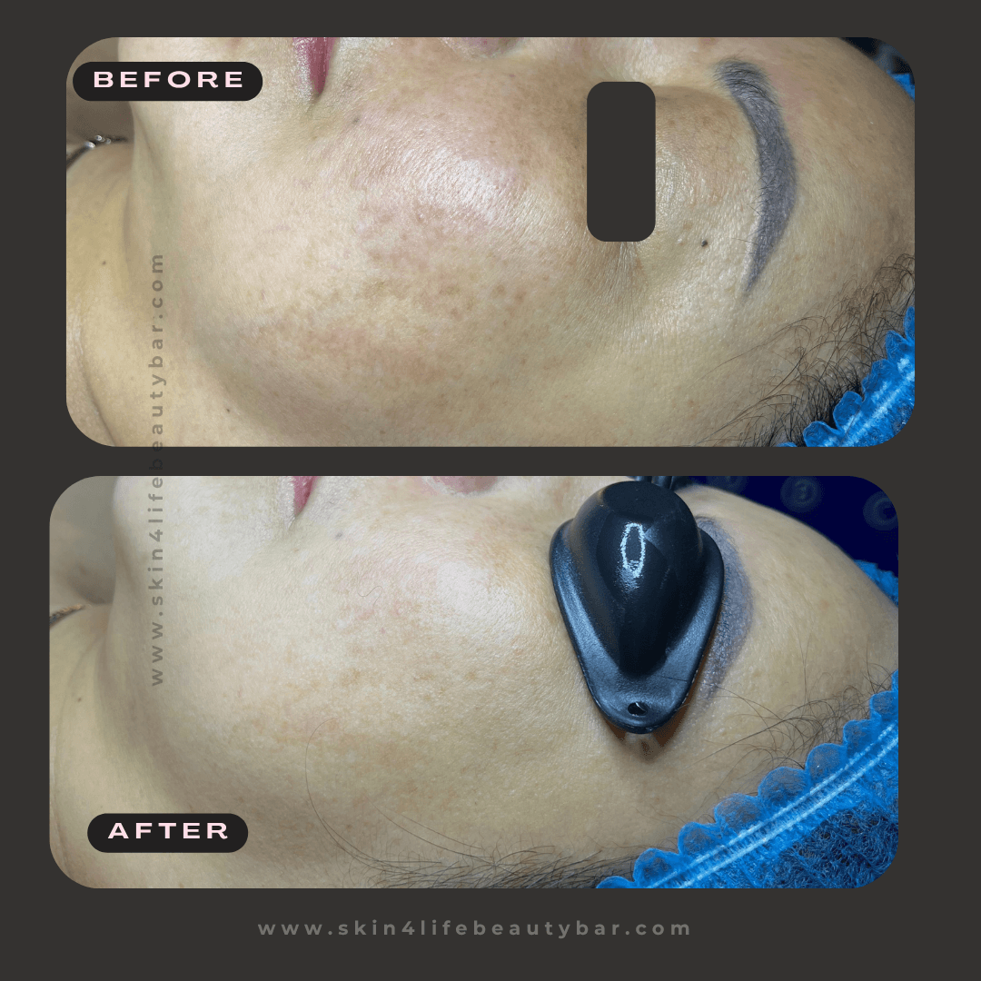 Microneedling before and after — result 1