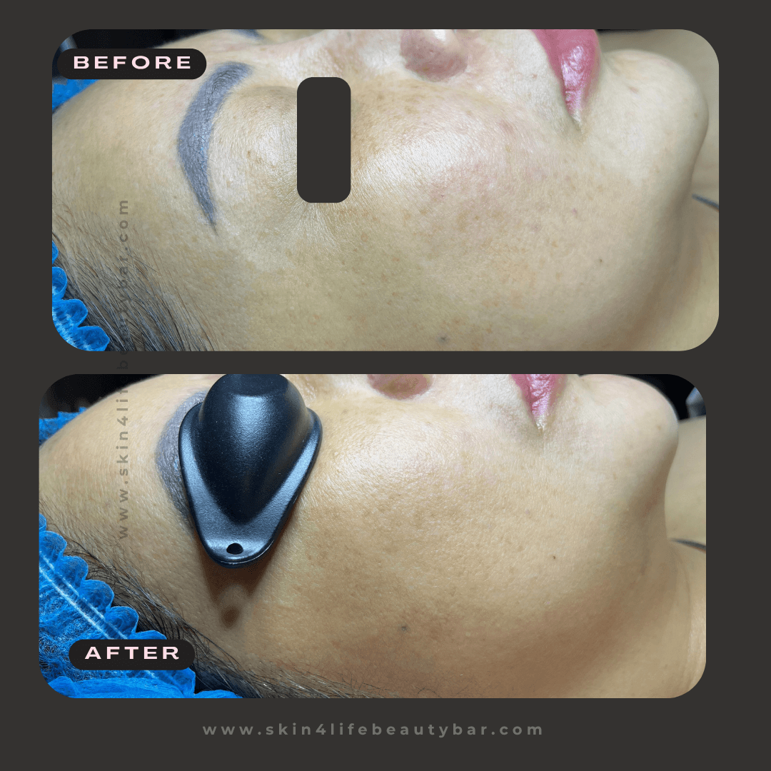 Microneedling before and after — result 2