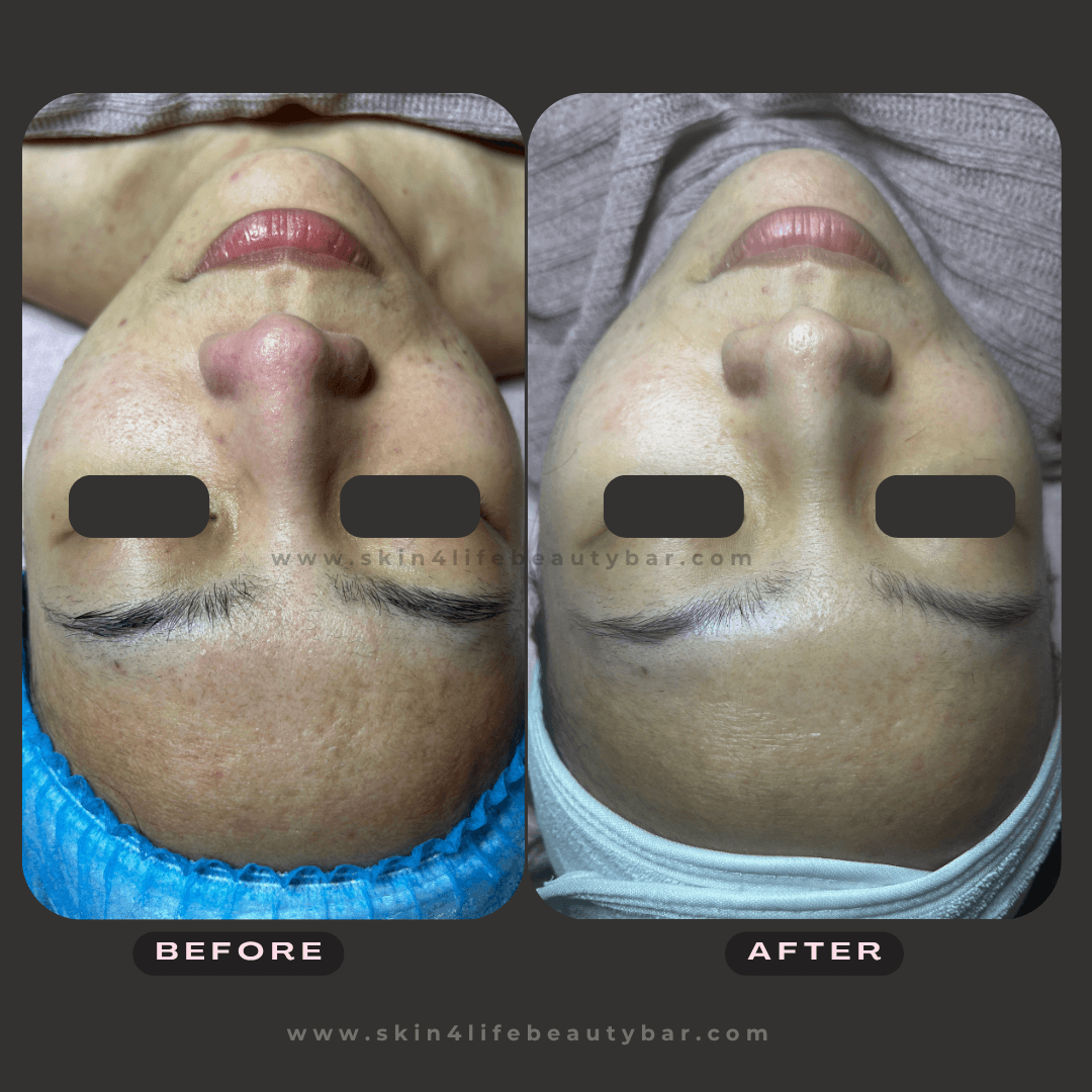 Microneedling before and after — result 3