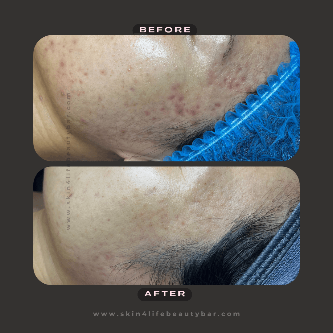 Microneedling before and after — result 4