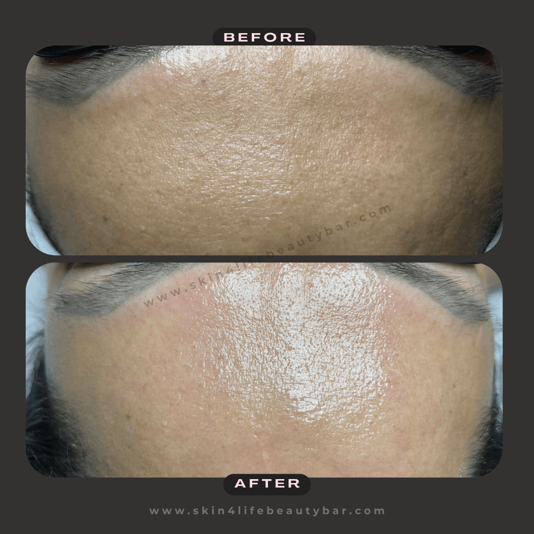 Nano-Mesotherapy before and after — result 1