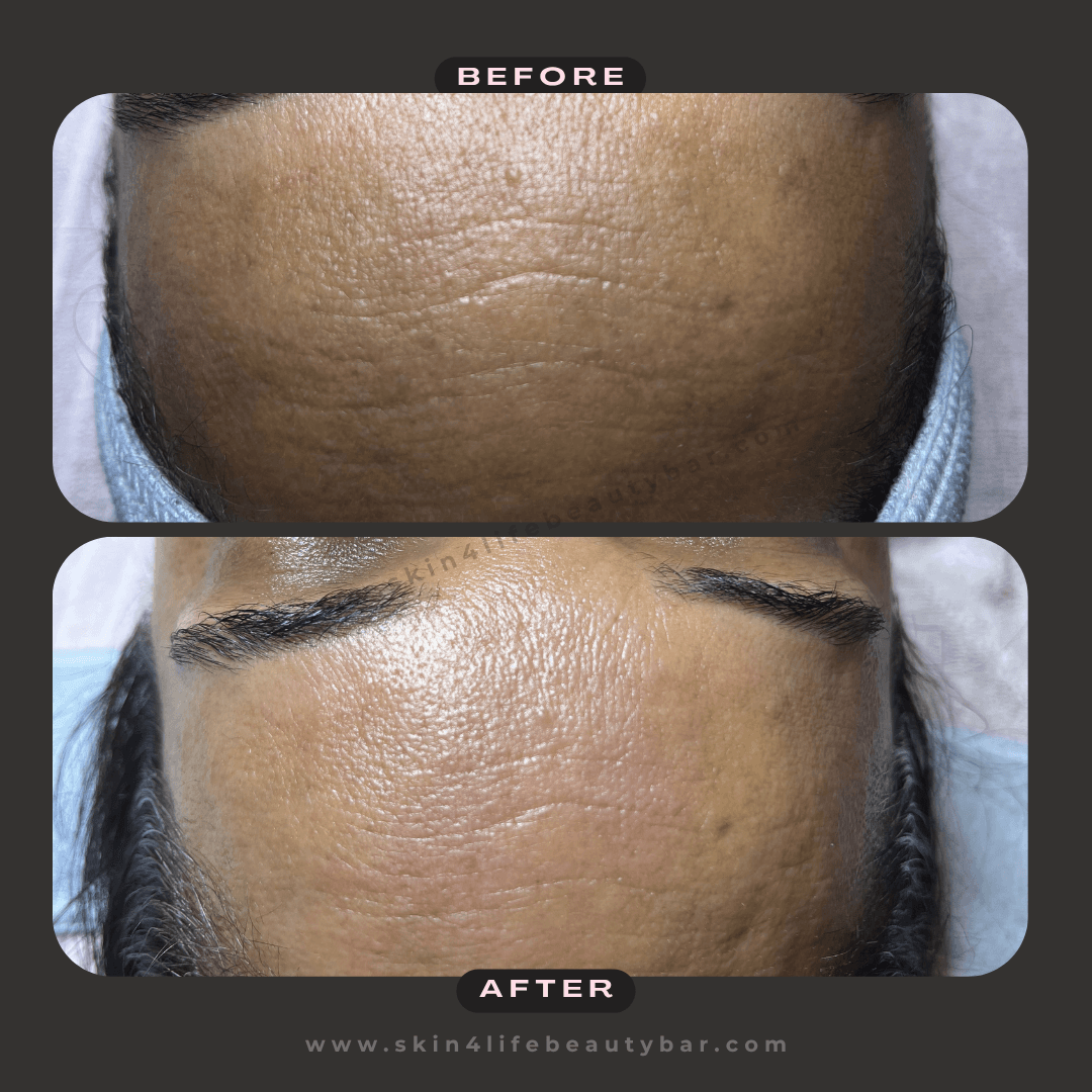 Nano-Mesotherapy before and after — result 2