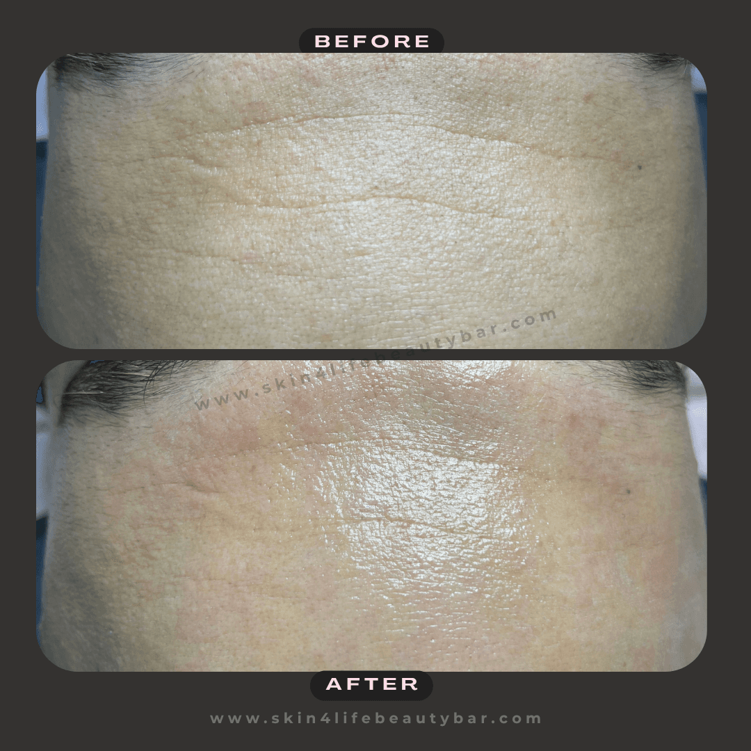 Nano-Mesotherapy before and after — result 3