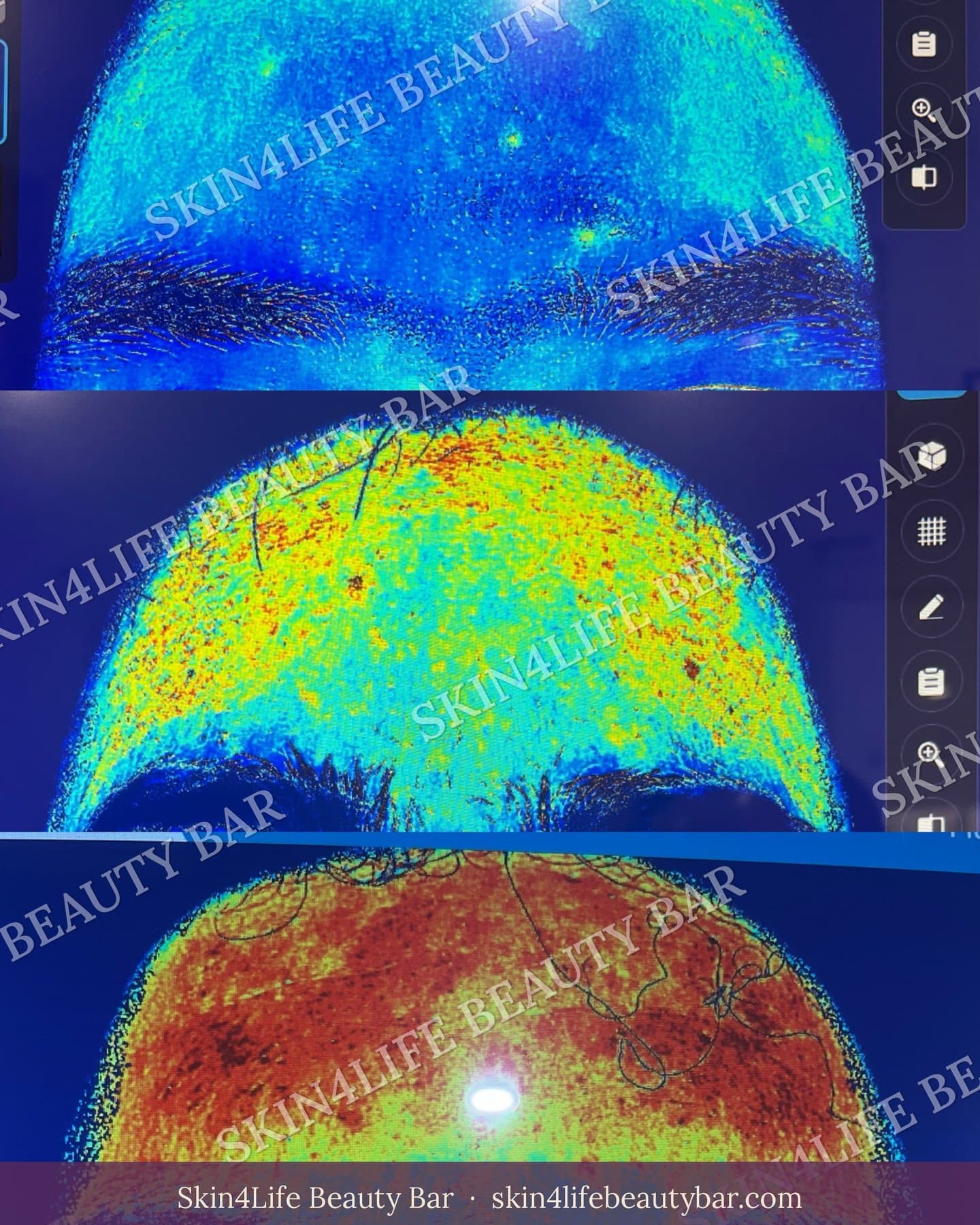 AI skin scan of foreheads showing calm blue areas versus red inflammation signal.